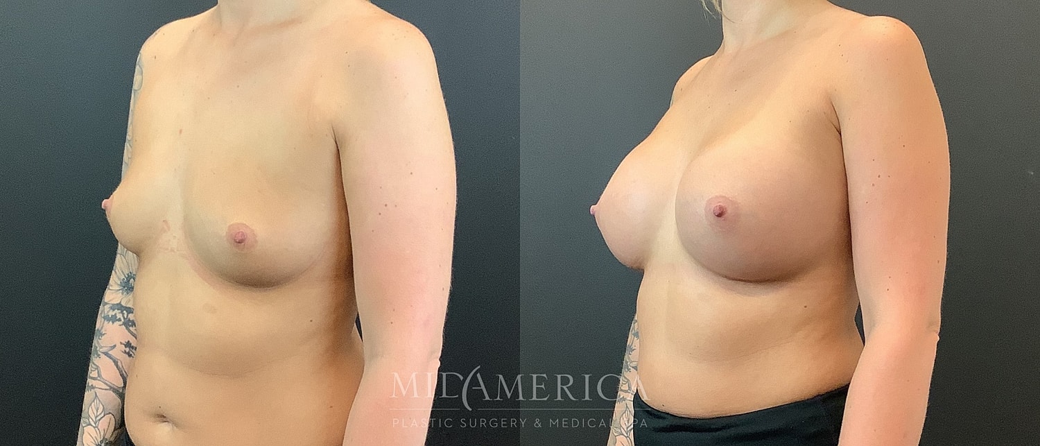 Breast augmentation before and after comparison.