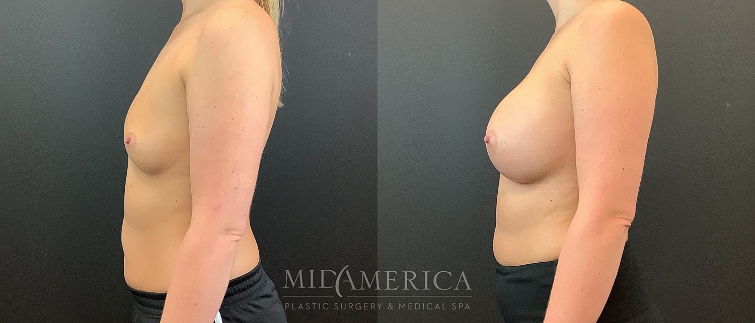 Before and after breast enhancement comparison image.
