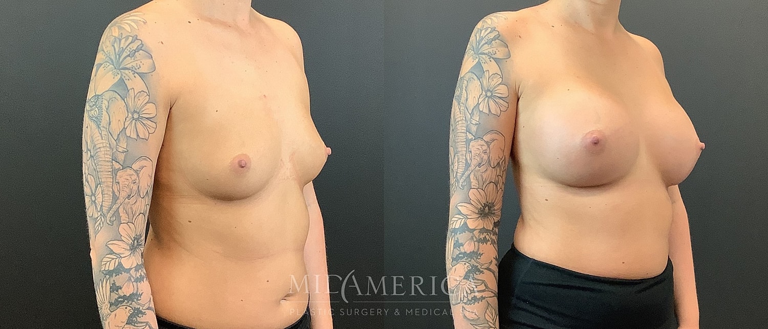 Before and after breast augmentation comparison.