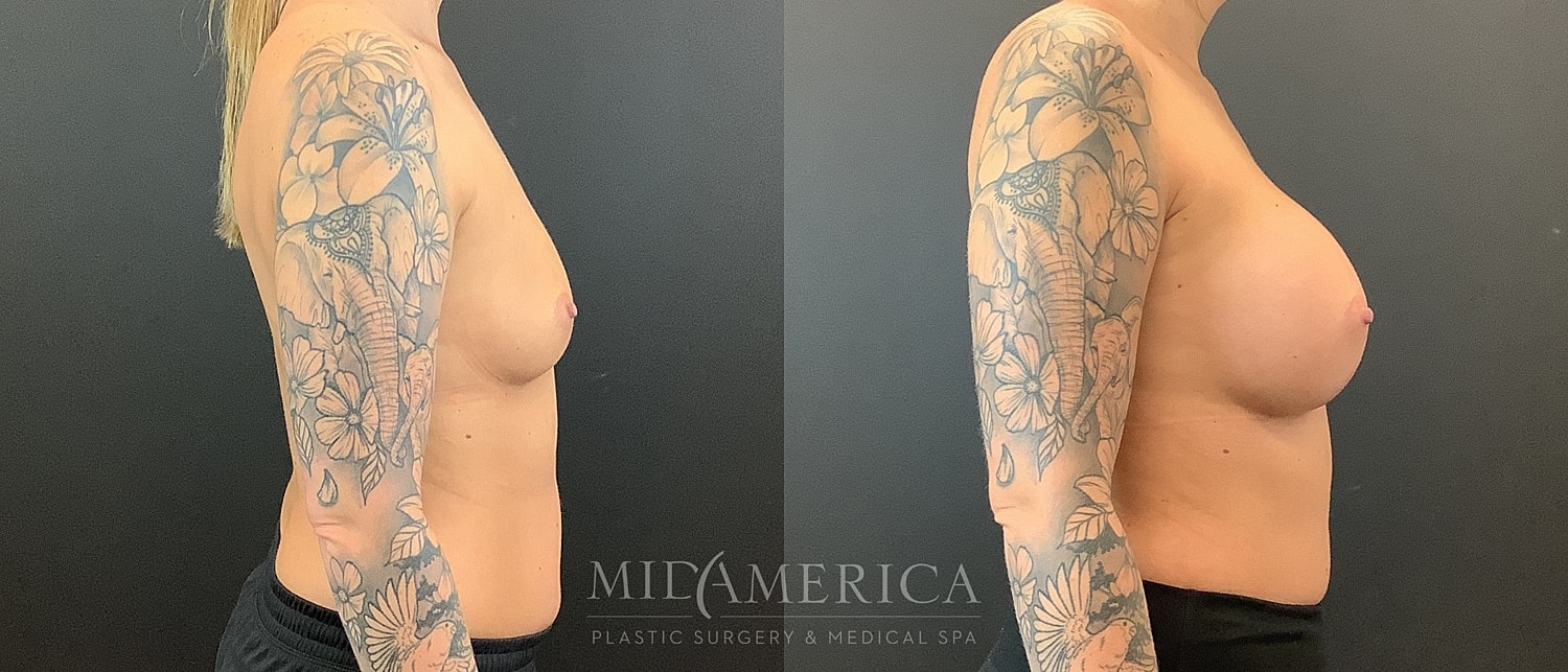 Before and after breast augmentation photos.