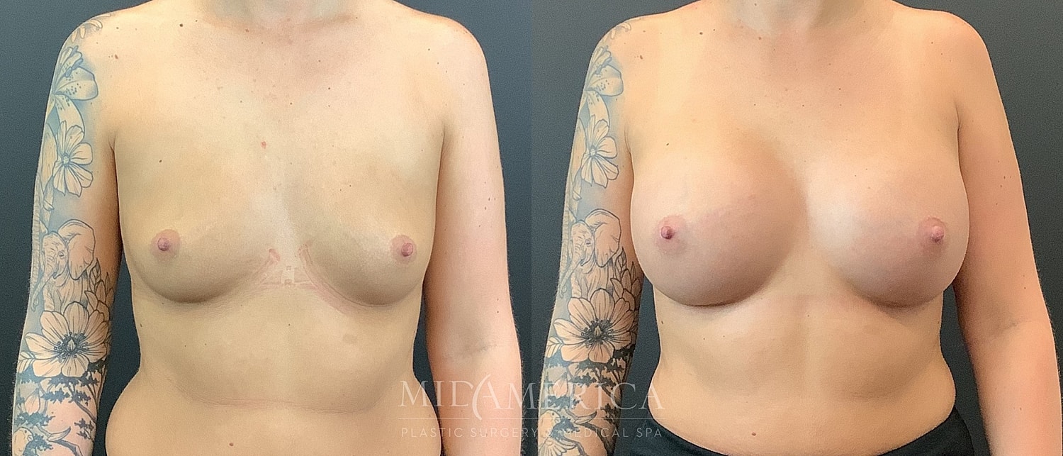 Before and after breast augmentation comparison photo.