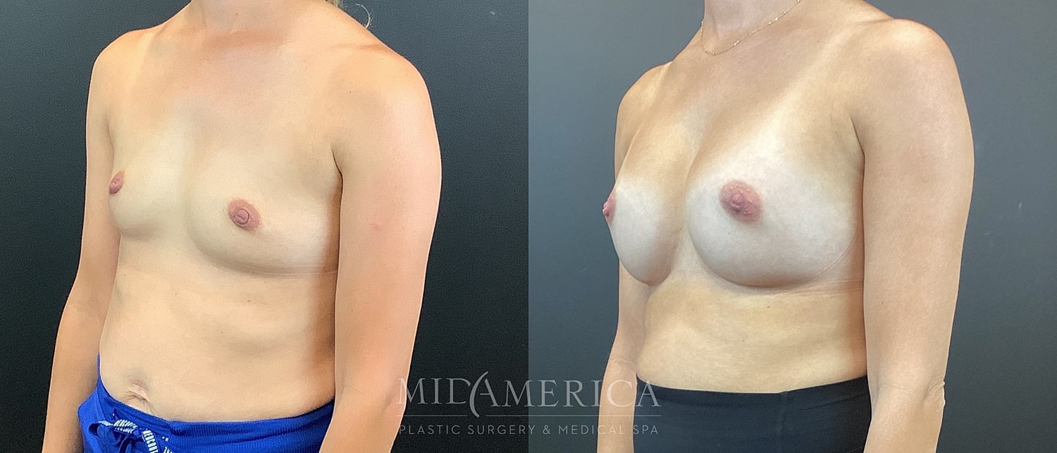 Breast Augmentation Before & After