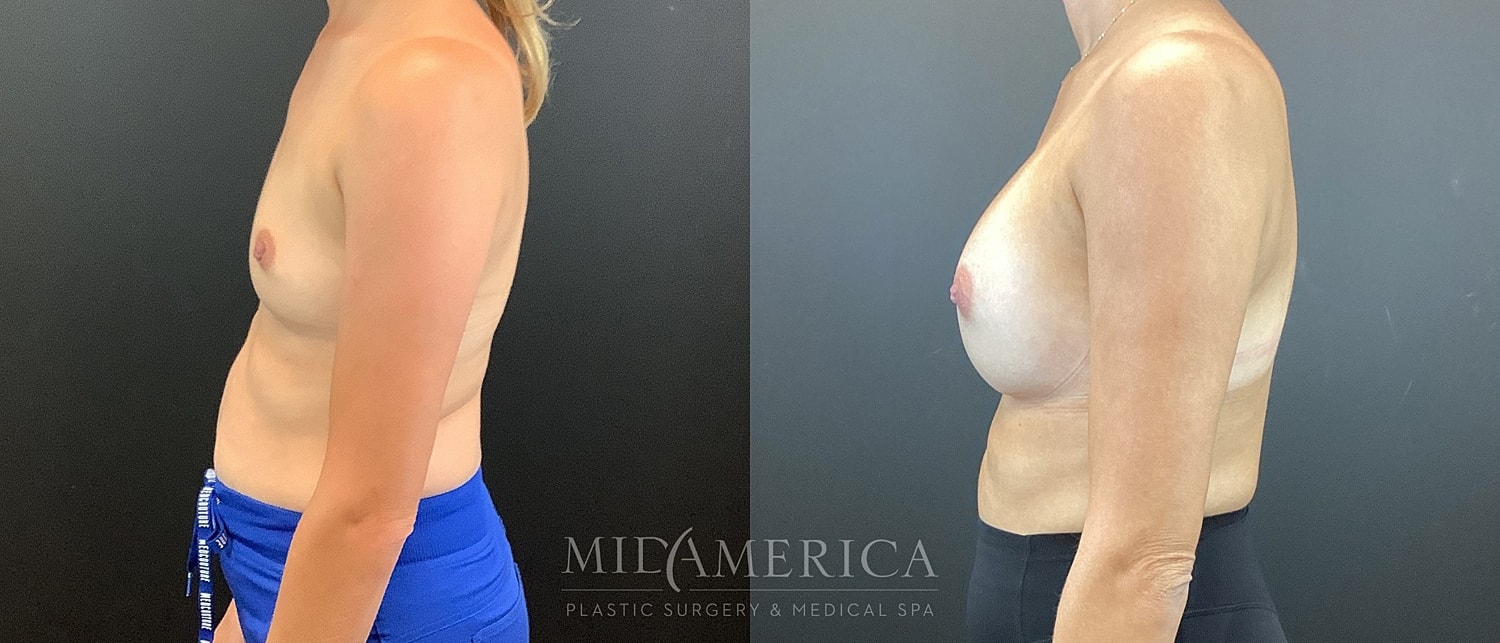 Breast Augmentation Before & After