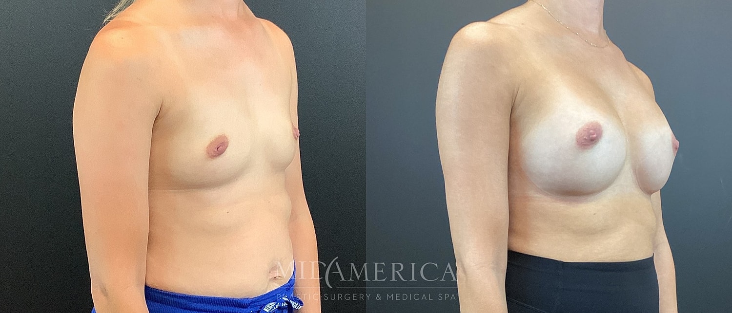 Breast Augmentation Before & After