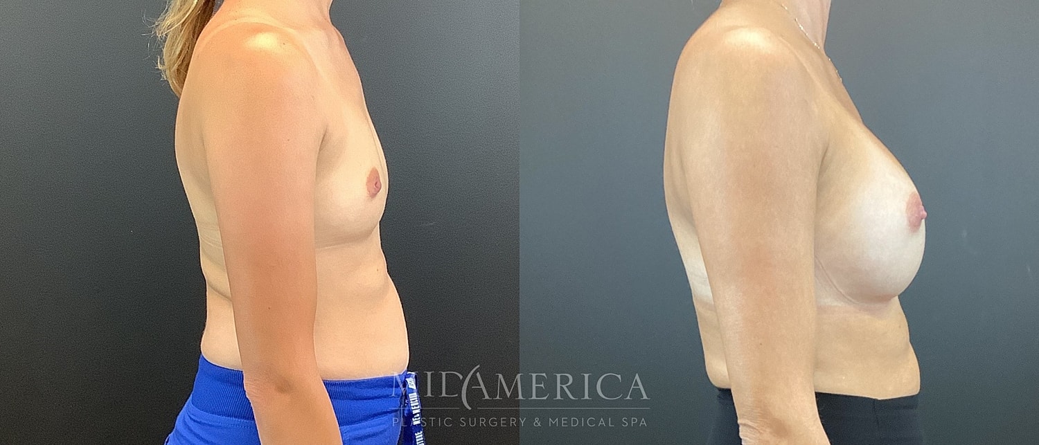 Breast Augmentation Before & After