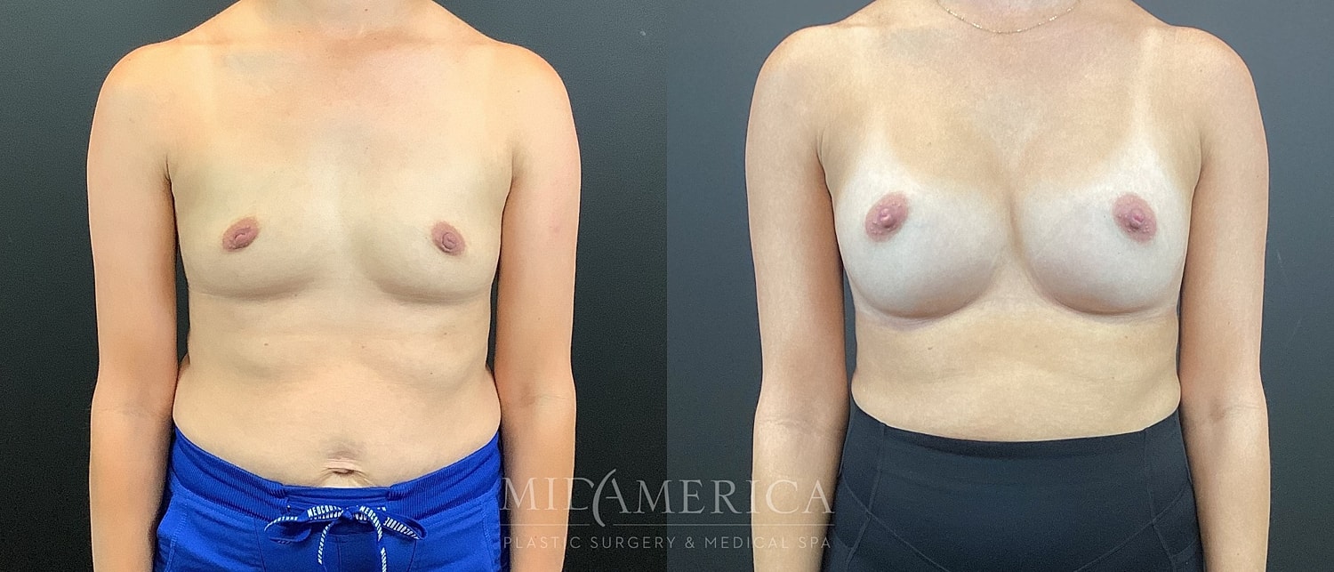Breast Augmentation Before & After