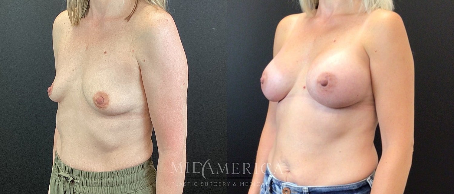 Breast Augmentation Before & After