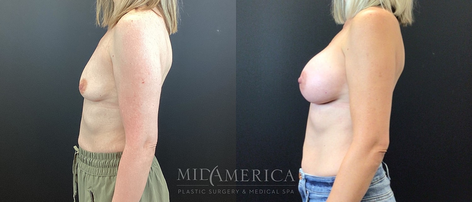 Breast Augmentation Before & After