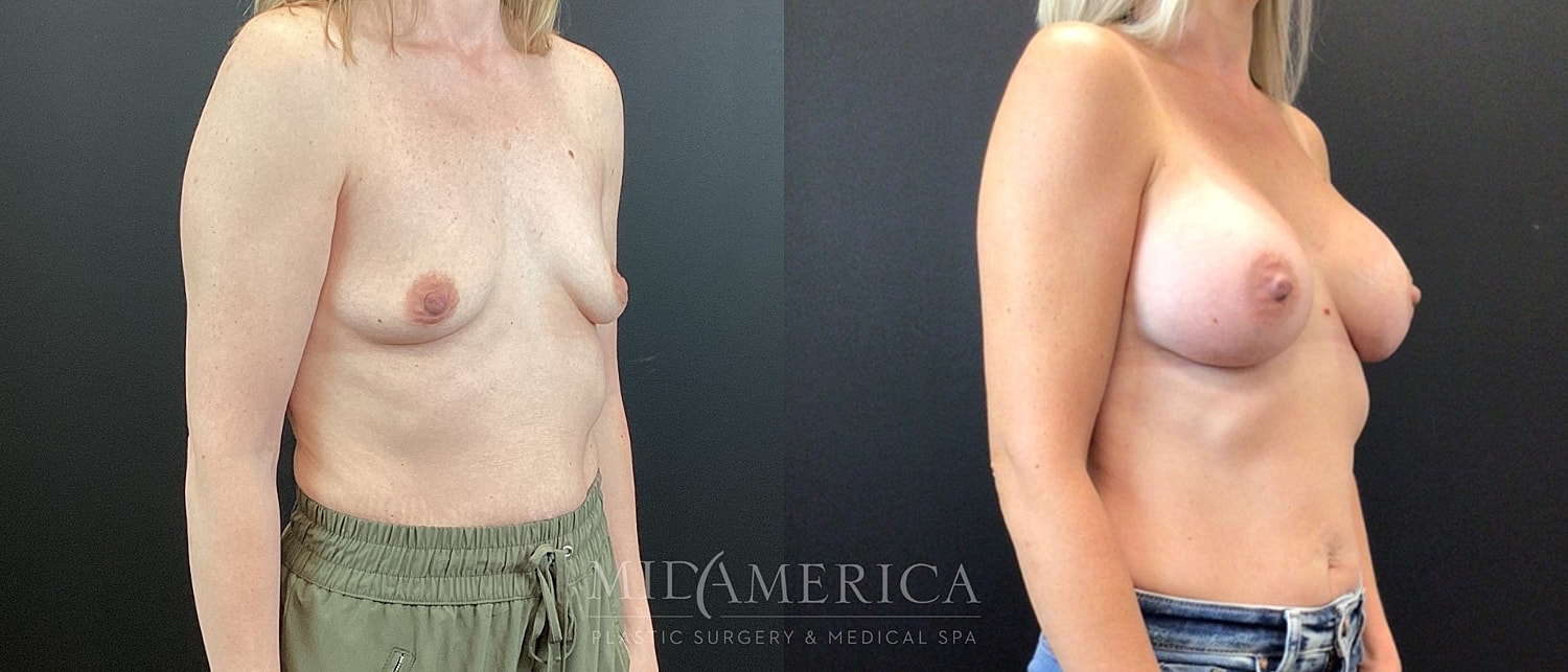 Breast Augmentation Before & After
