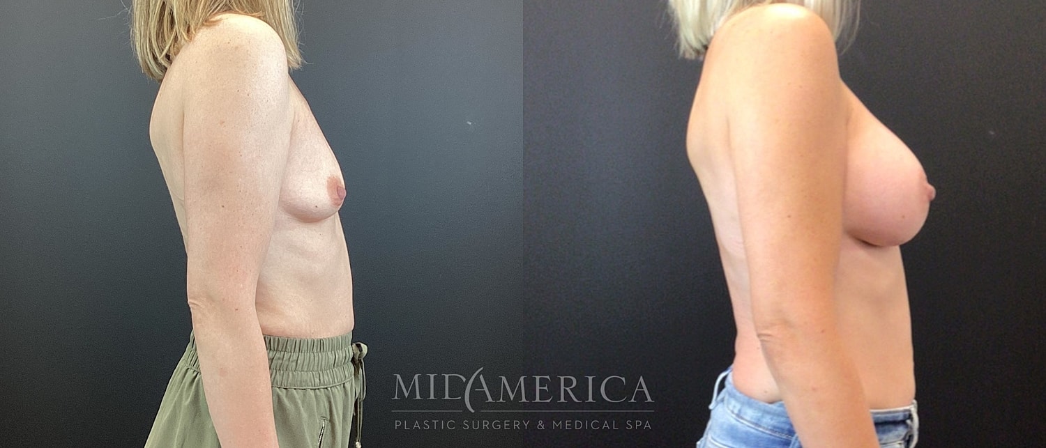Breast Augmentation Before & After