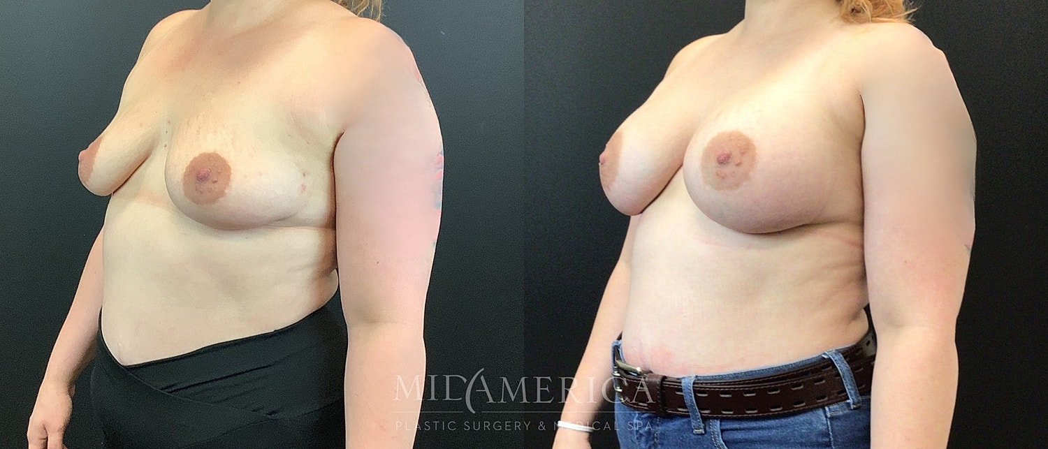 Breast Augmentation Before & After
