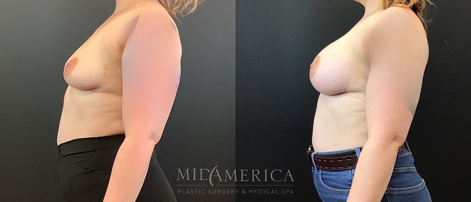 Breast Augmentation Before & After