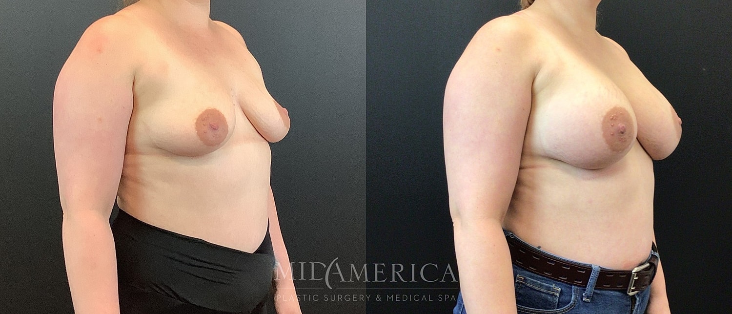 Breast Augmentation Before & After