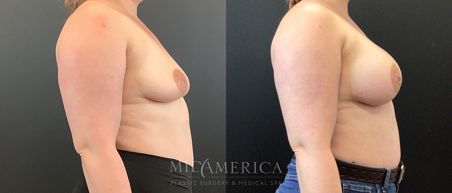 Breast Augmentation Before & After
