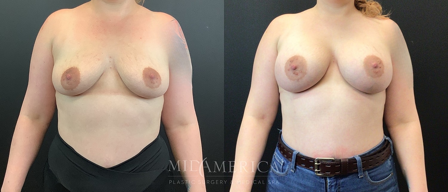 Breast Augmentation Before & After