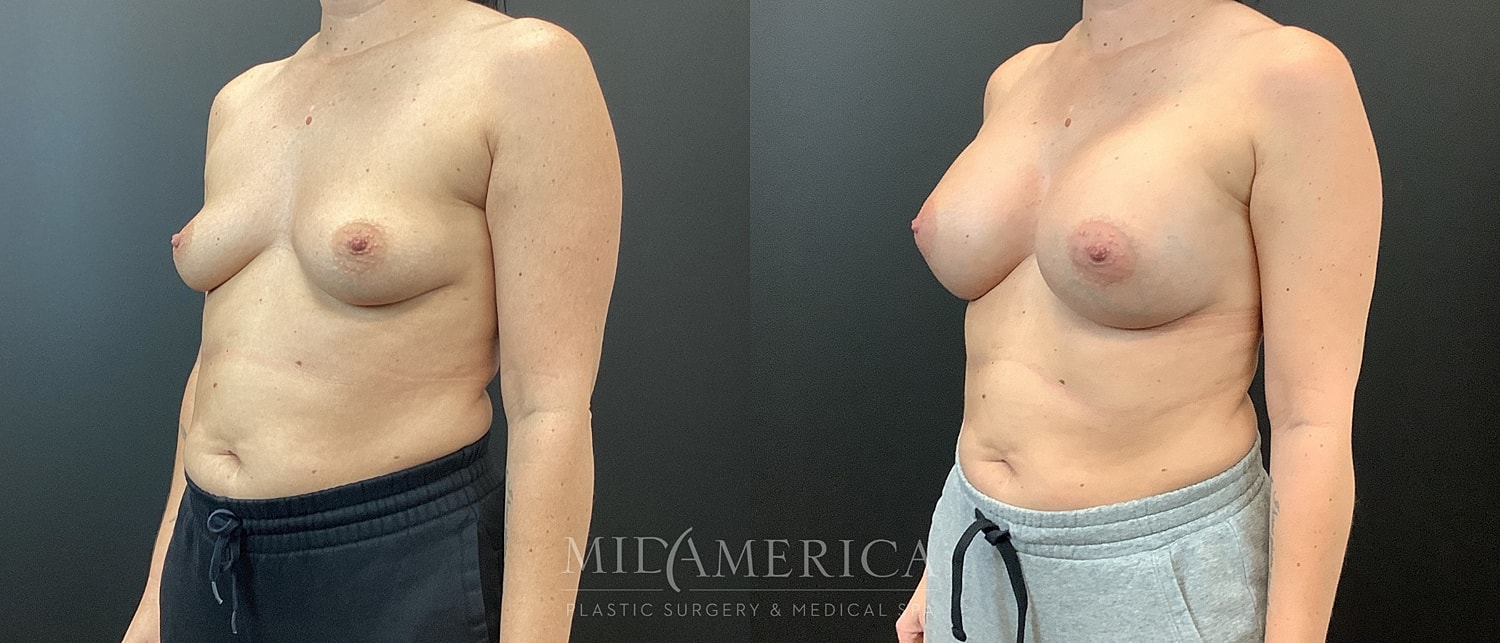 Breast Augmentation Before & After