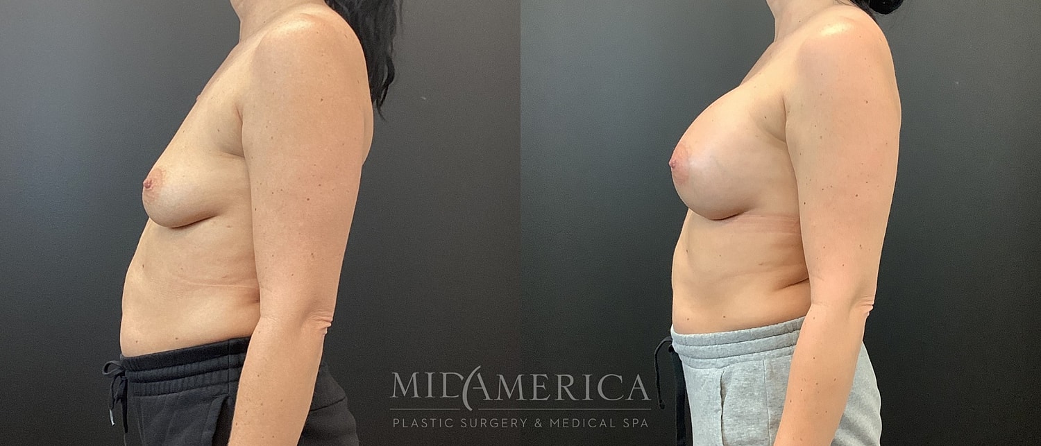 Breast Augmentation Before & After