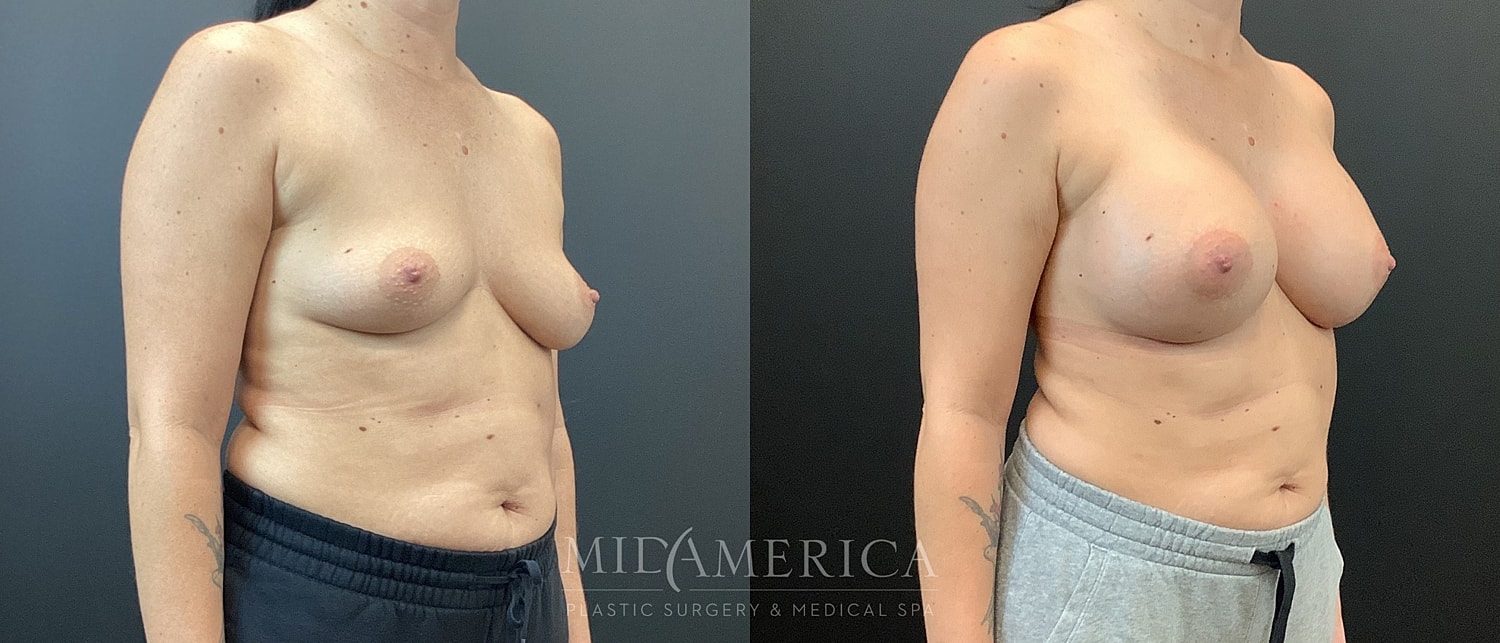 Breast Augmentation Before & After