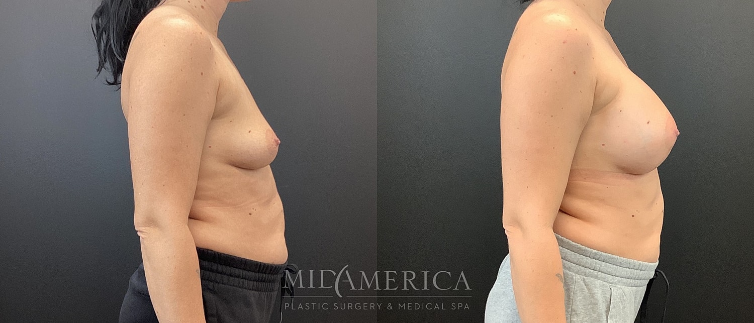 Breast Augmentation Before & After