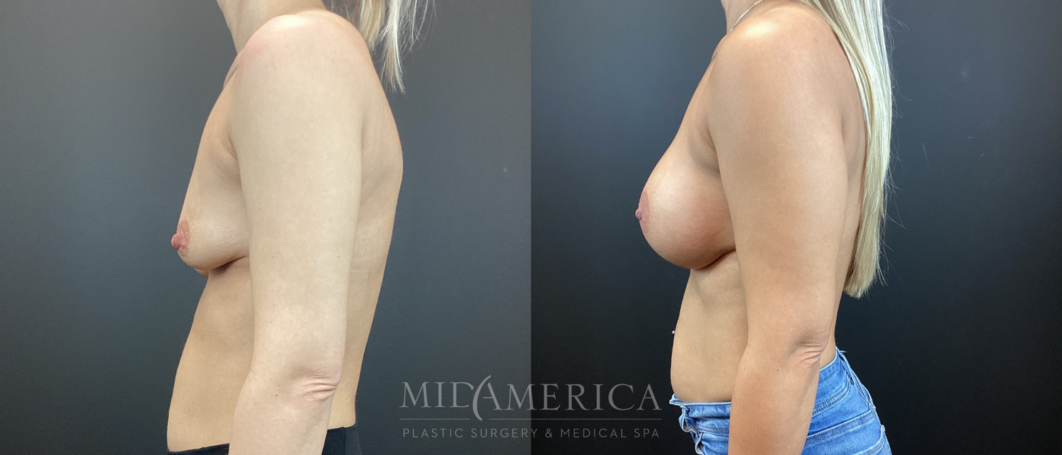 Breast Augmentation Before & After