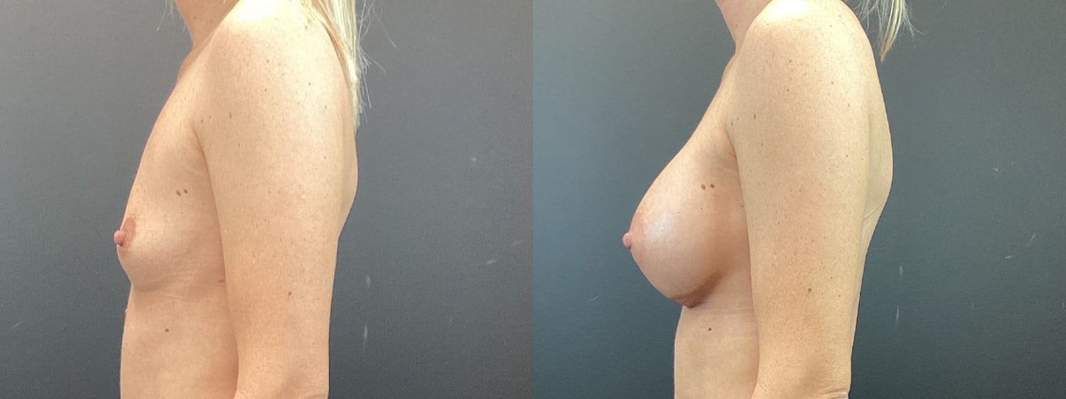 Breast Augmentation Before & After