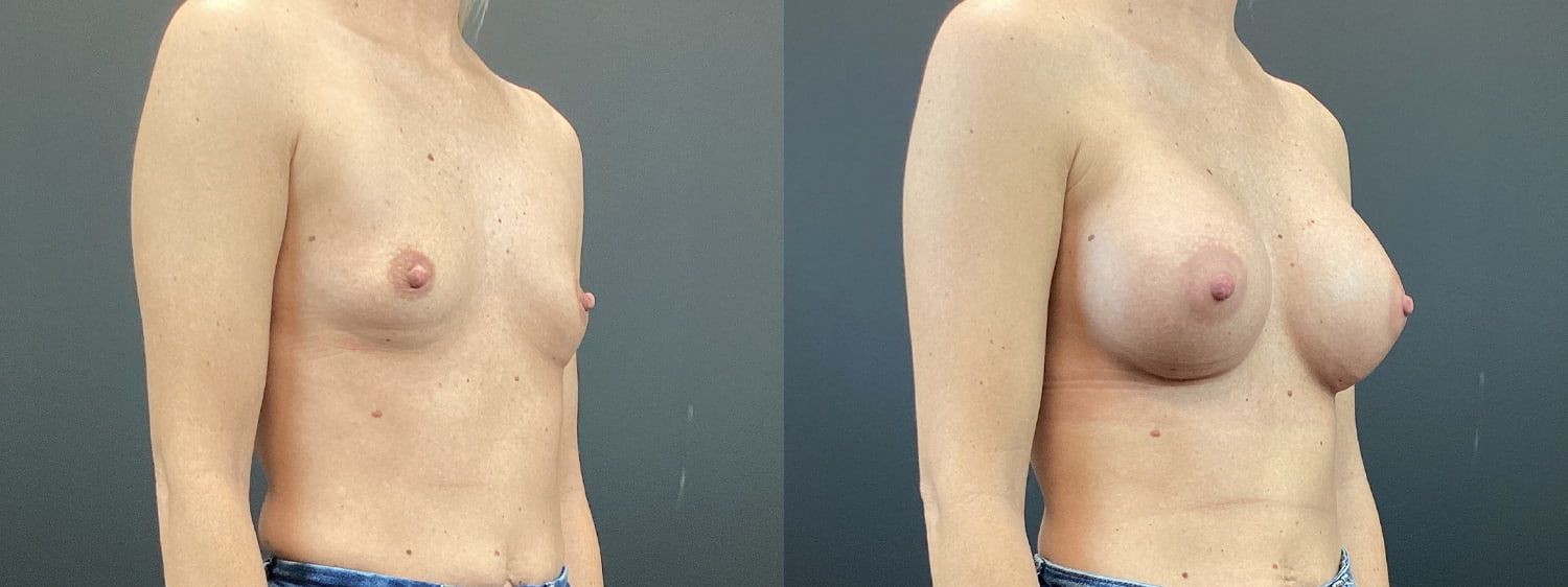 Breast Augmentation Before & After