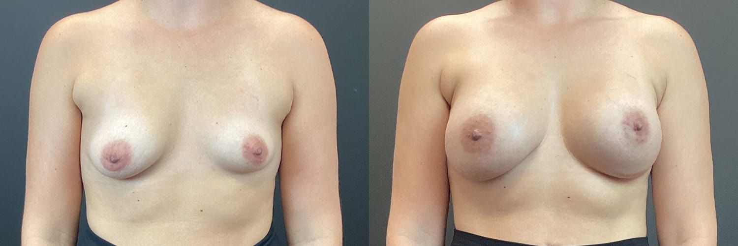 Breast Augmentation Before & After