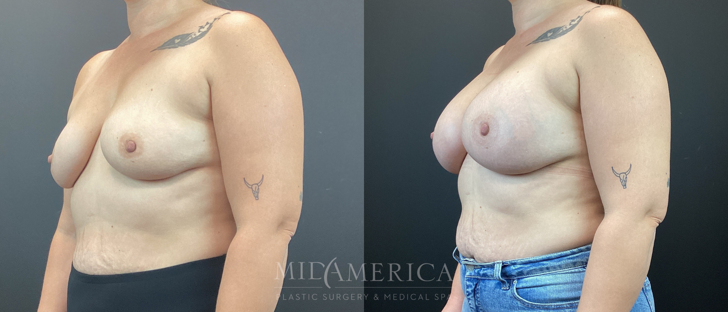 Breast Augmentation Before & After