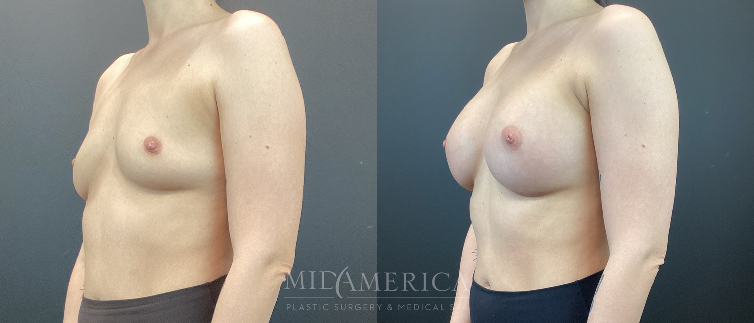 Breast Augmentation Before & After