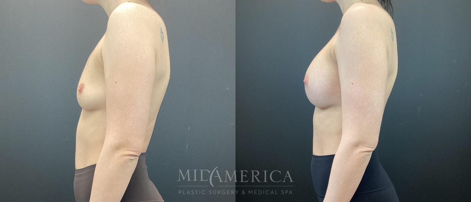 Breast Augmentation Before & After