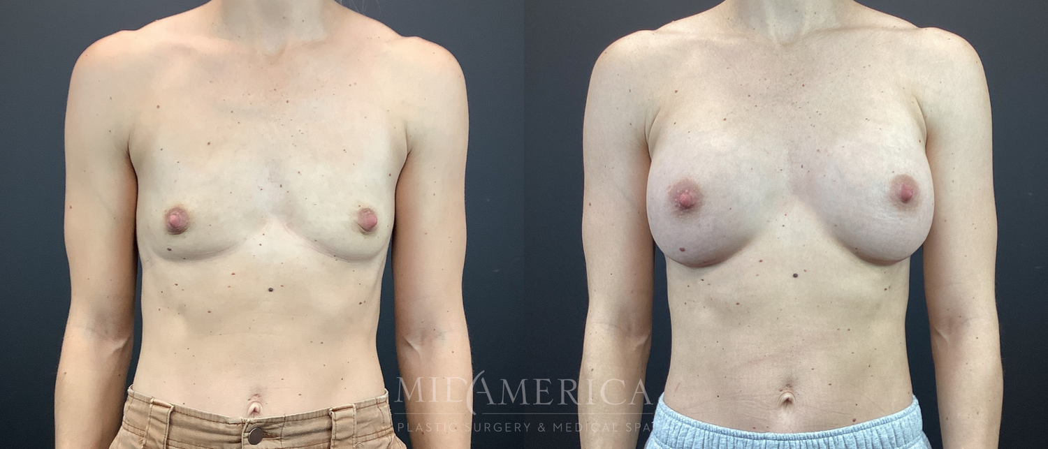 Breast Augmentation Before & After