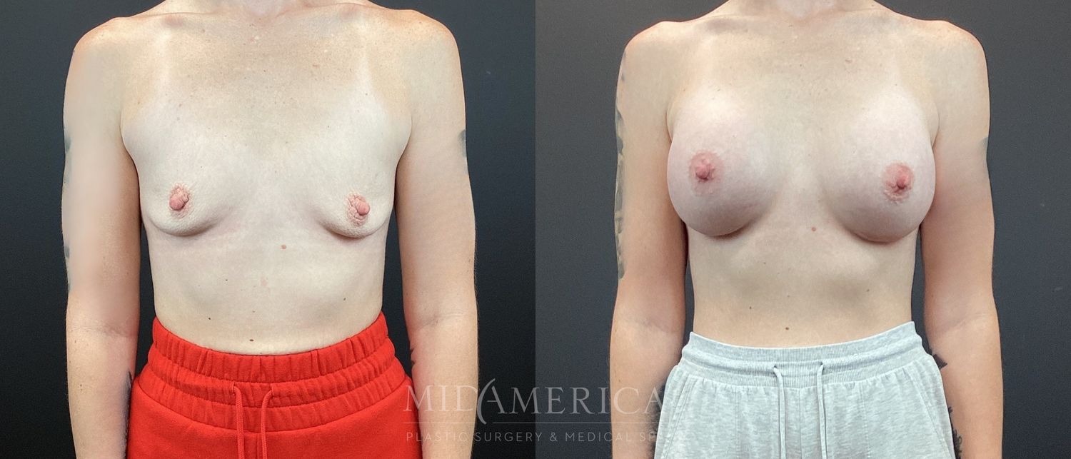 Breast Augmentation Before & After