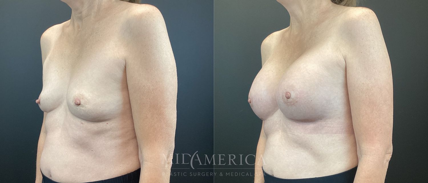 Breast Augmentation Before & After