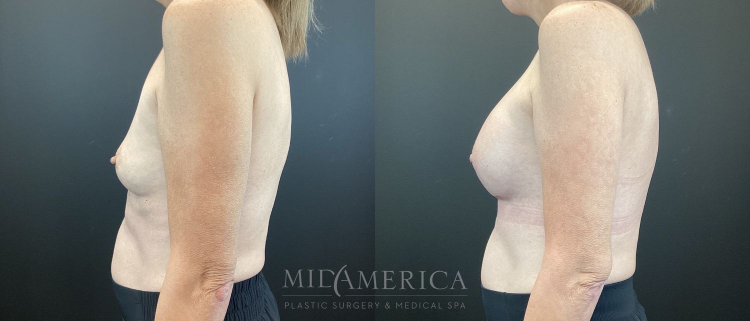 Breast Augmentation Before & After