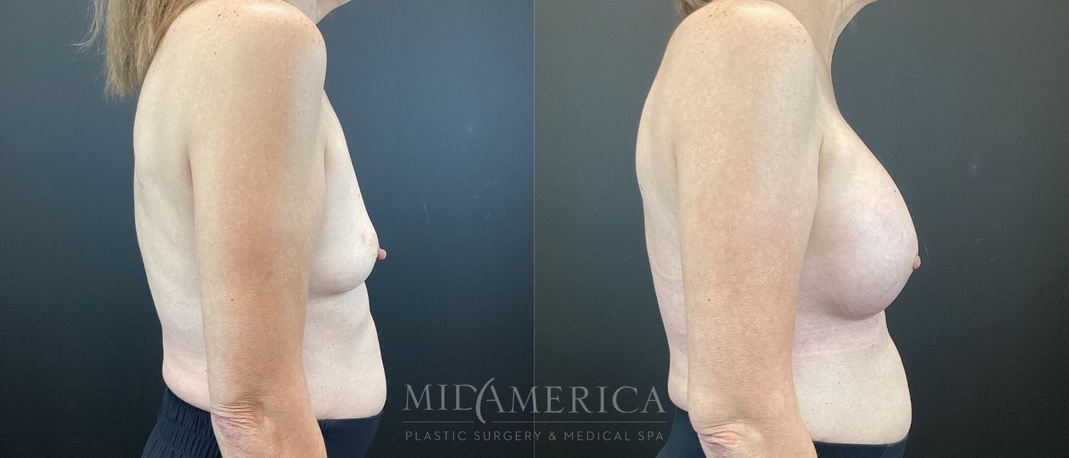Breast Augmentation Before & After