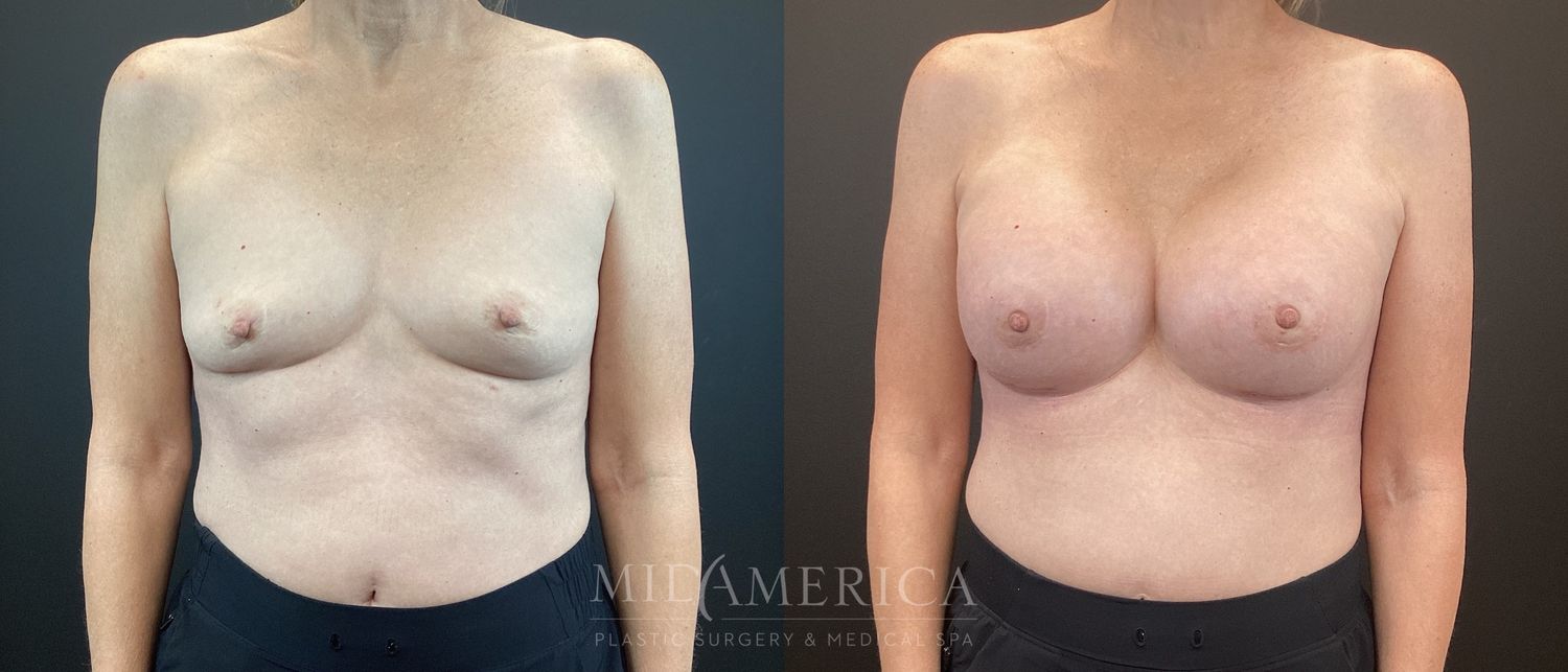 Breast Augmentation Before & After