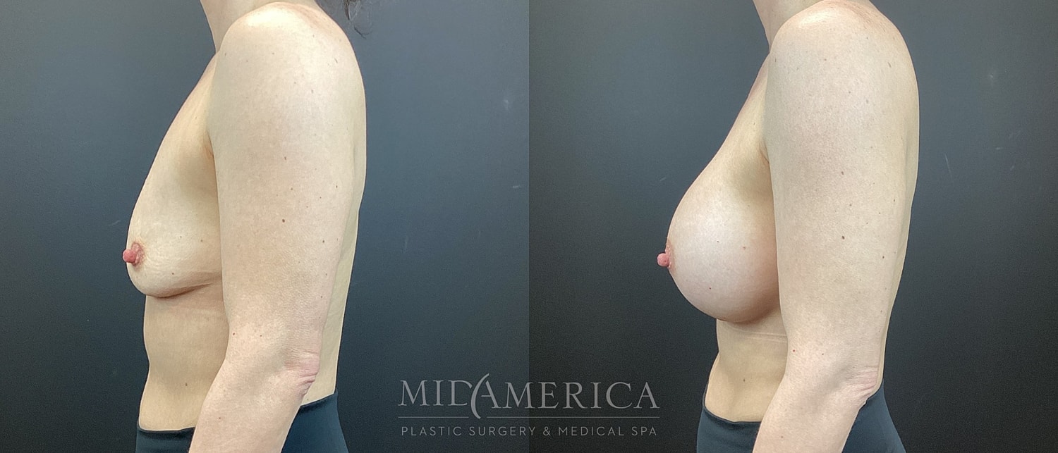 Breast Augmentation Before & After