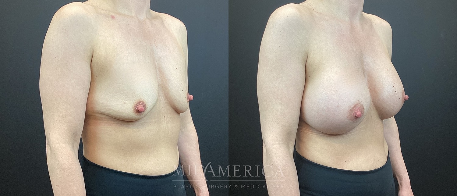 Breast Augmentation Before & After