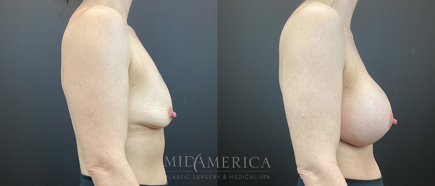 Breast Augmentation Before & After