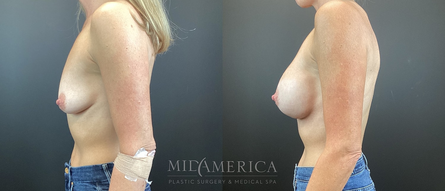 Breast Augmentation Before & After