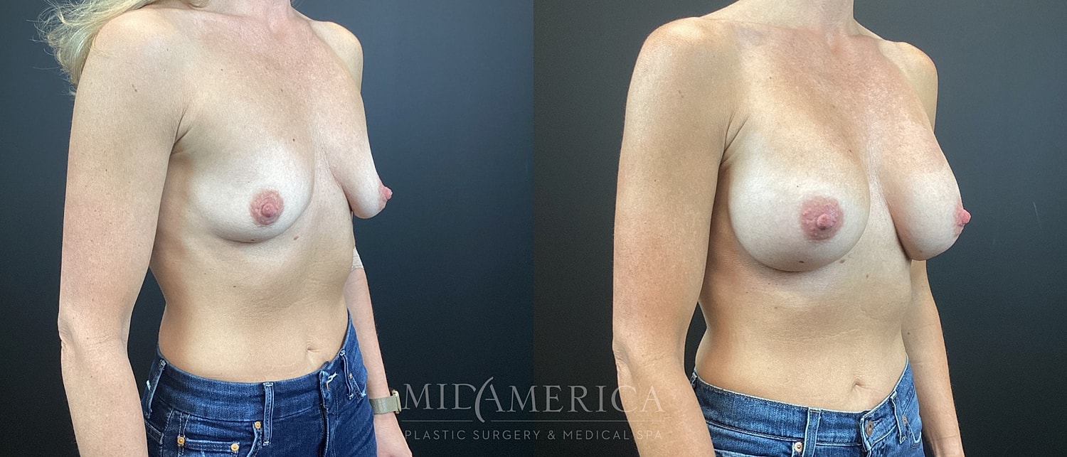 Breast Augmentation Before & After