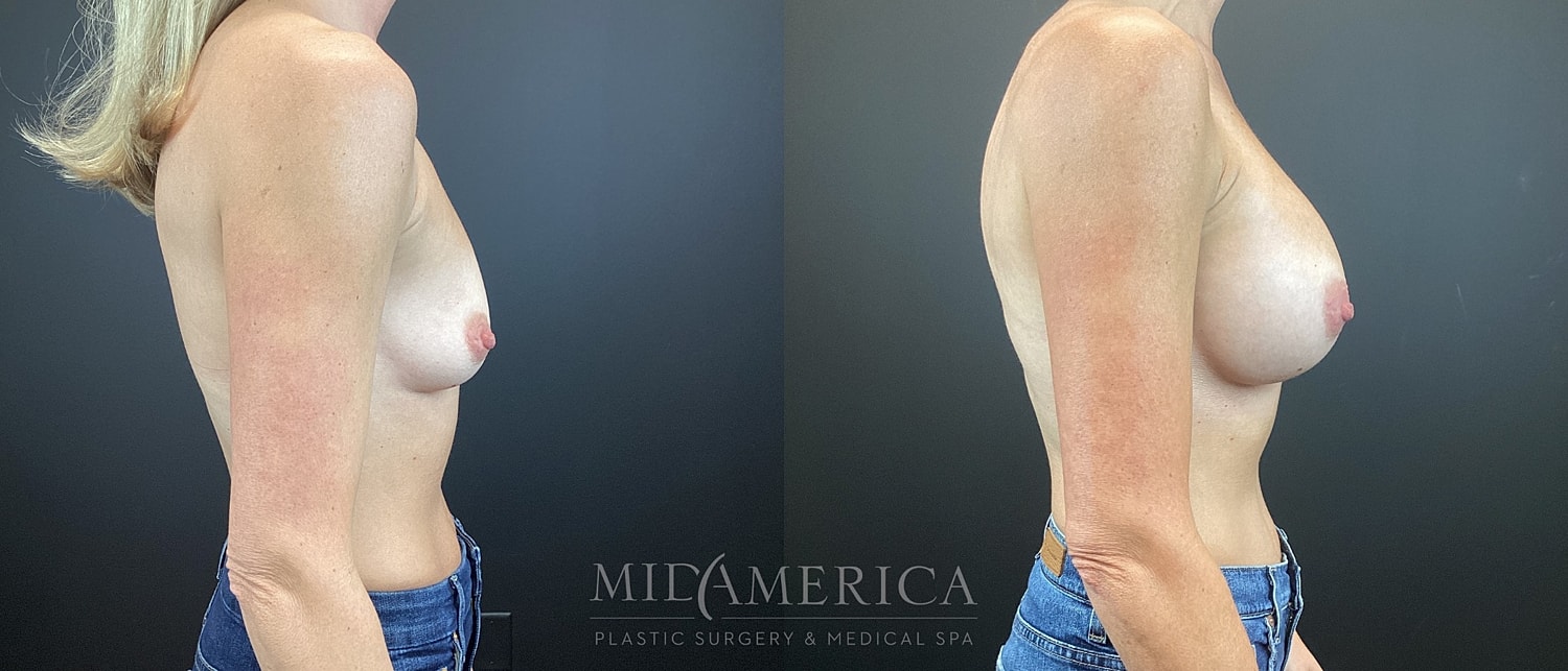 Breast Augmentation Before & After