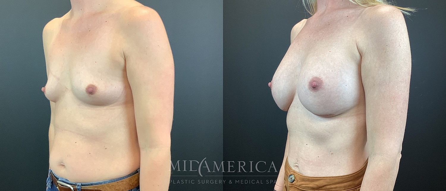 Breast Augmentation Before & After