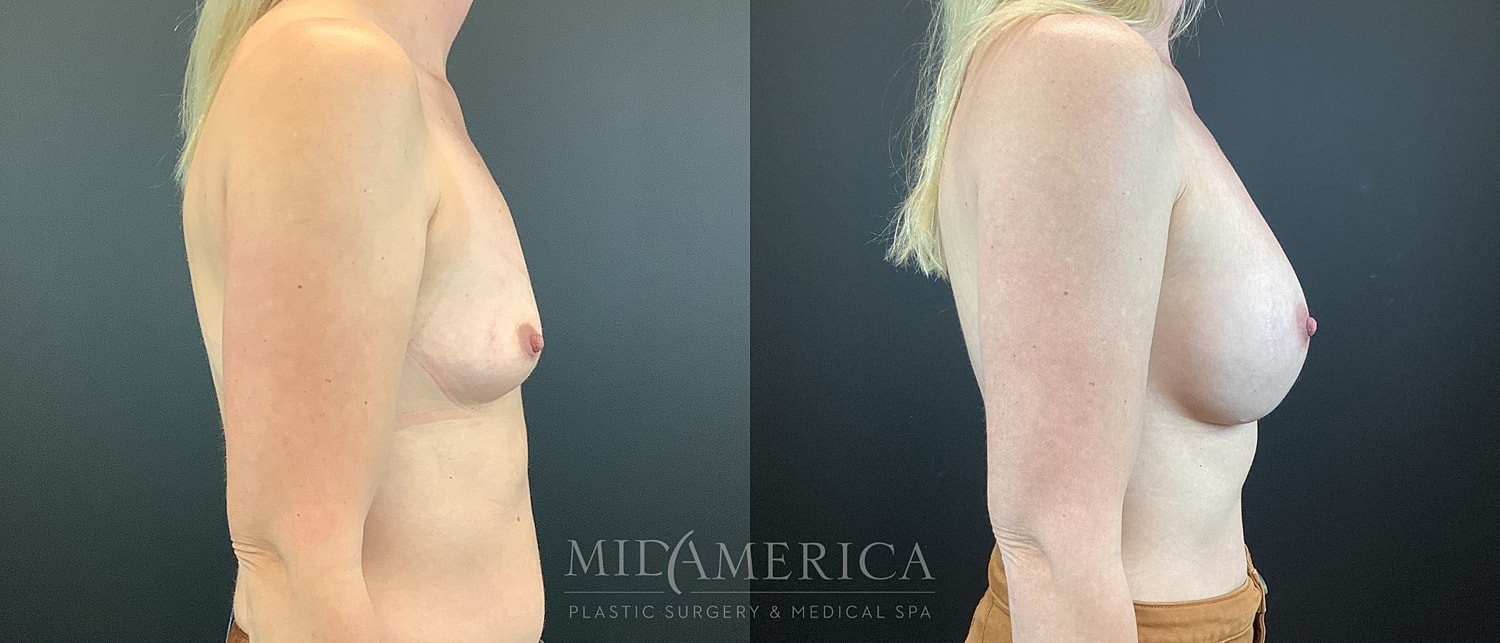 Breast Augmentation Before & After