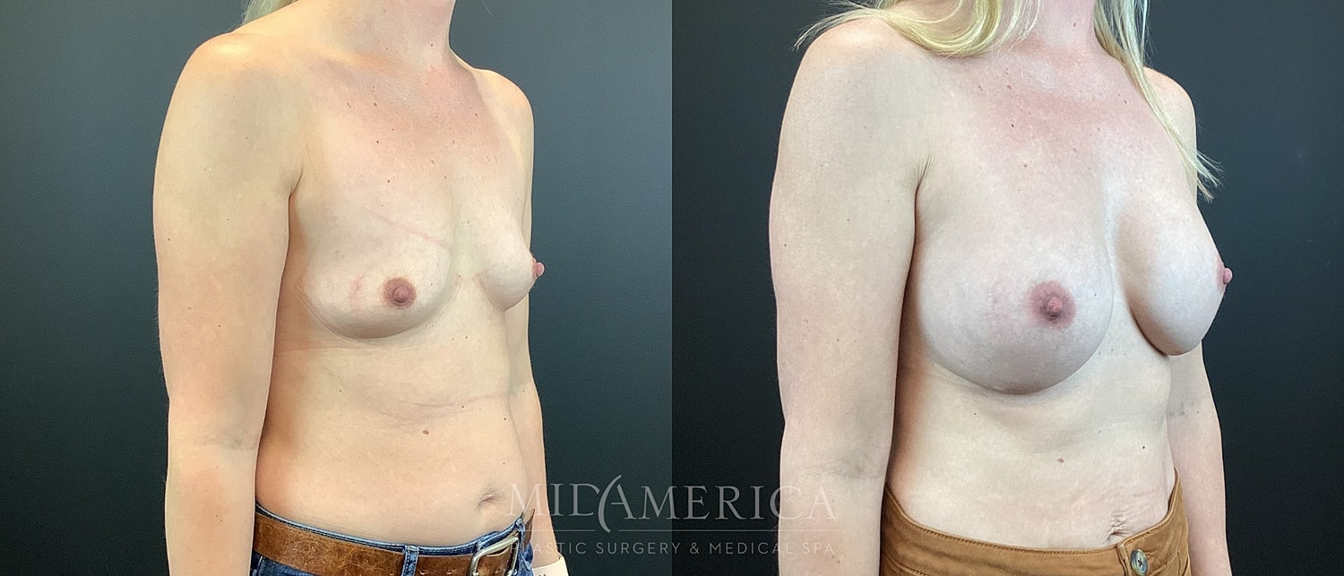 Breast Augmentation Before & After