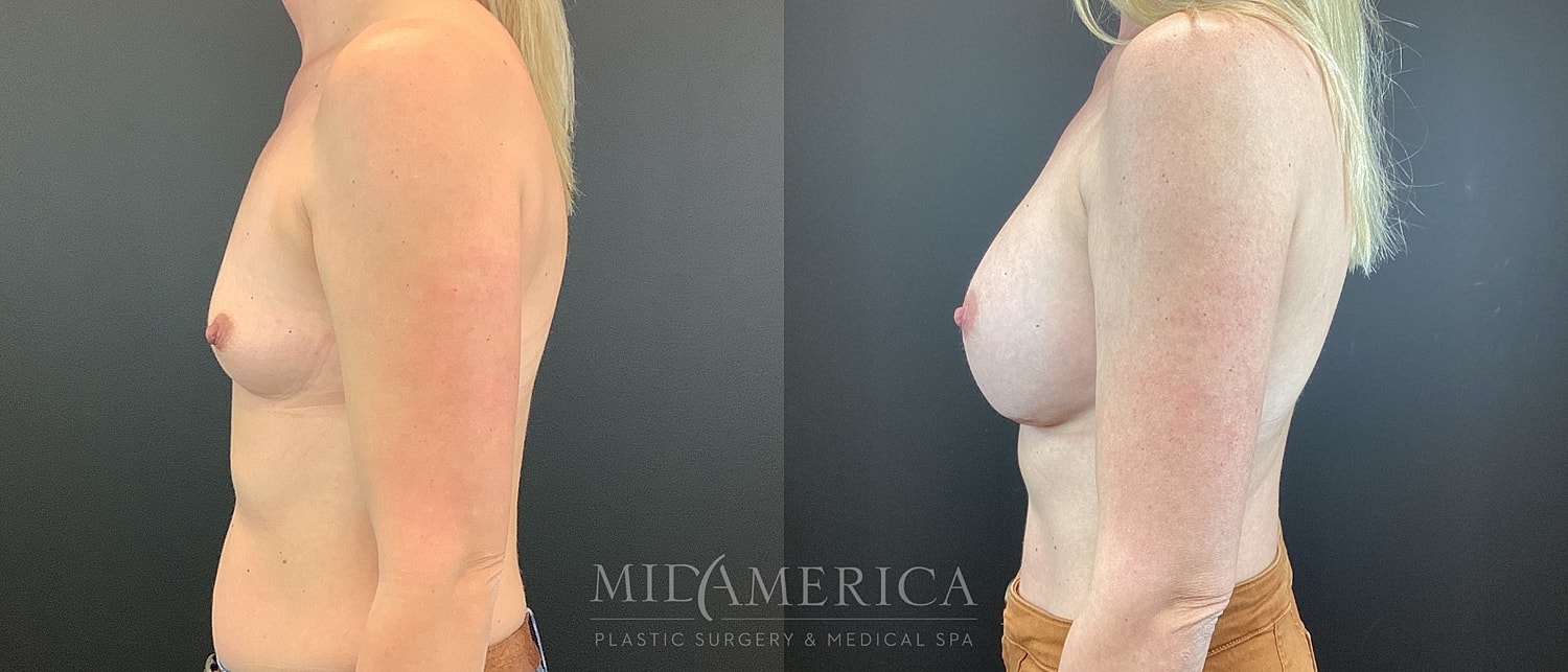 Breast Augmentation Before & After