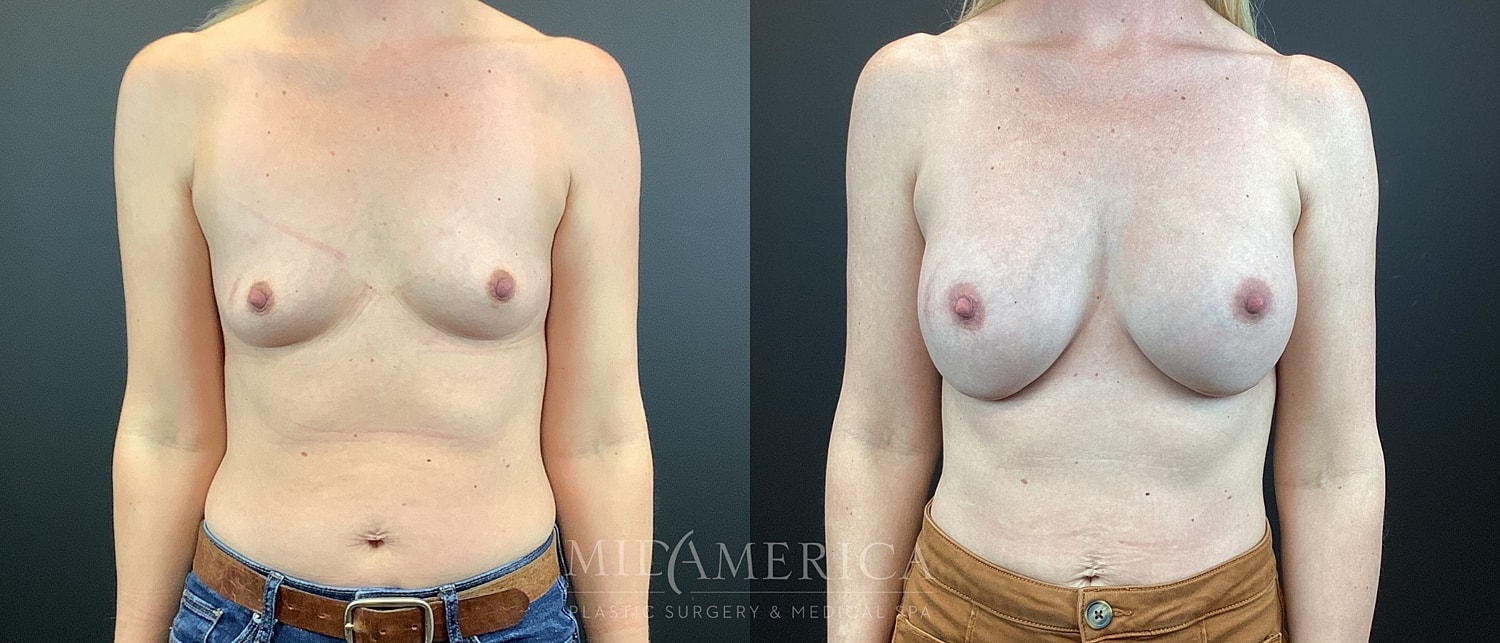 Breast Augmentation Before & After