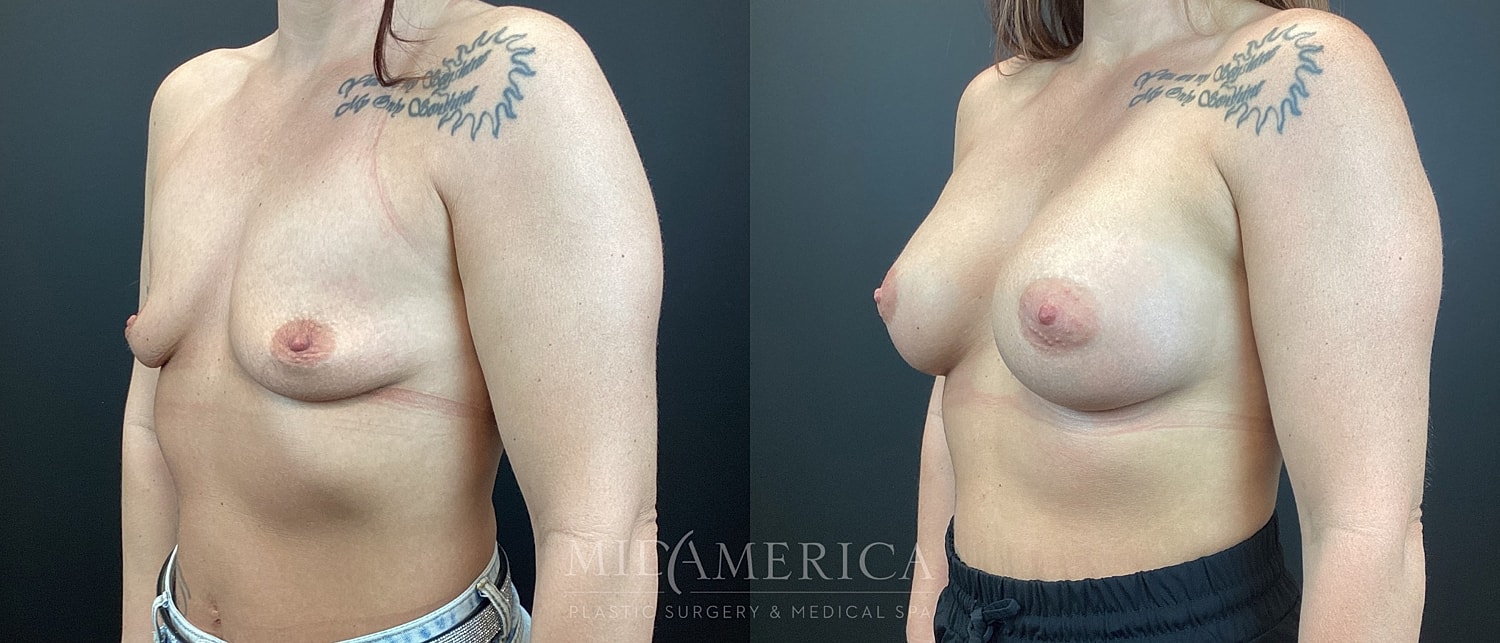 Breast Augmentation Before & After
