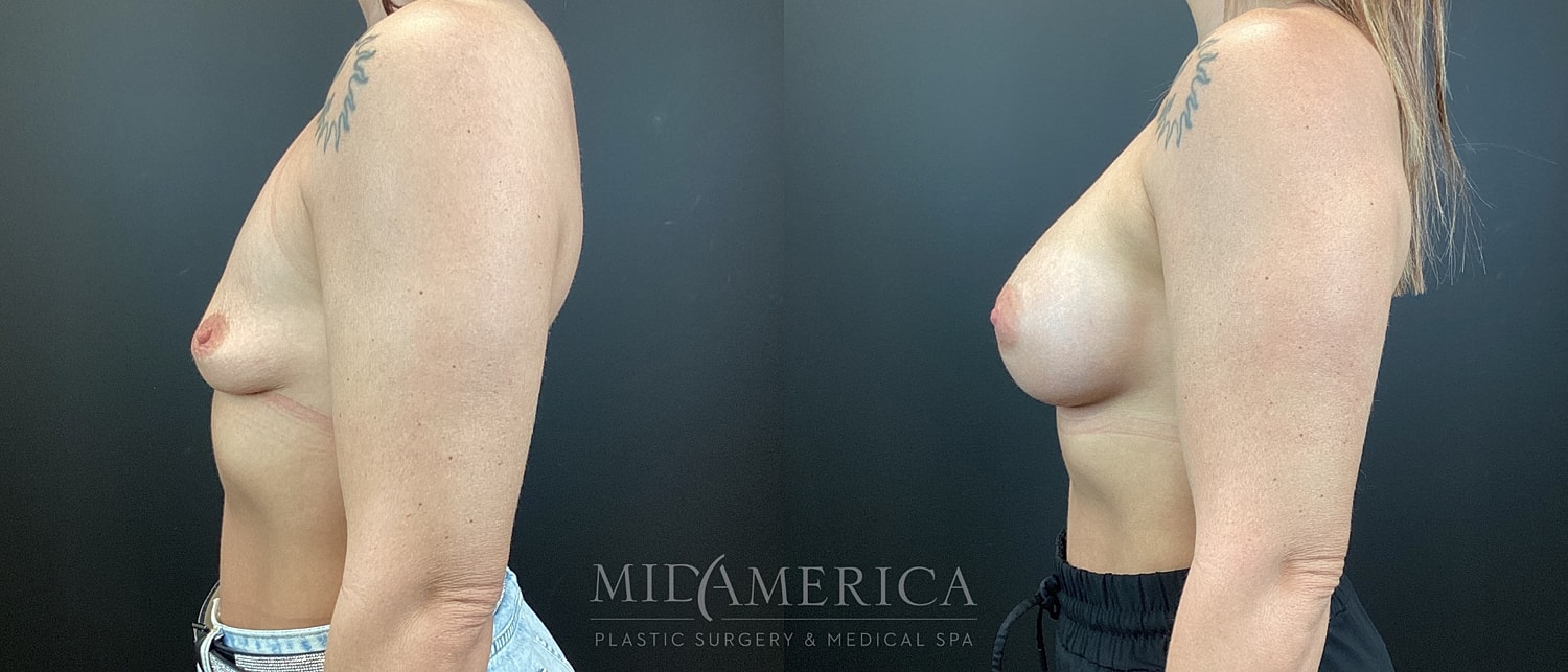 Breast Augmentation Before & After