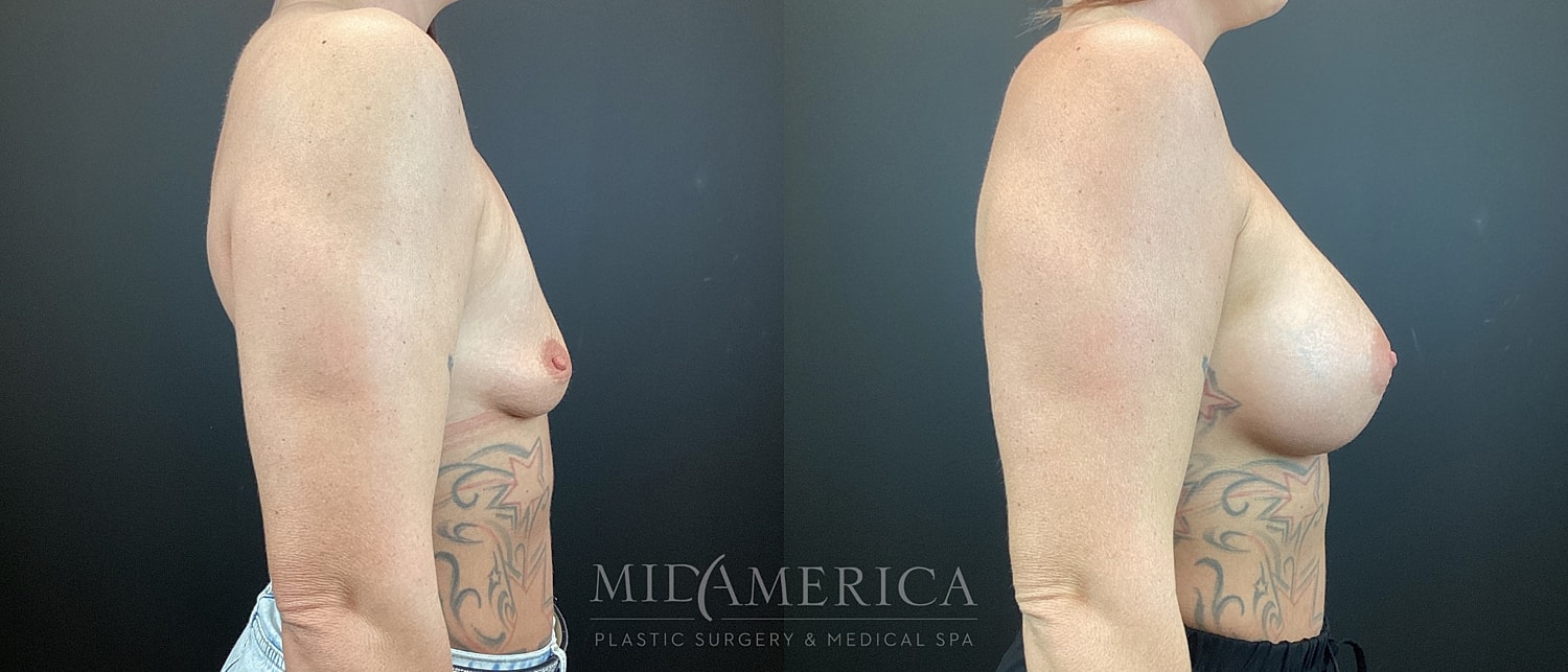 Breast Augmentation Before & After